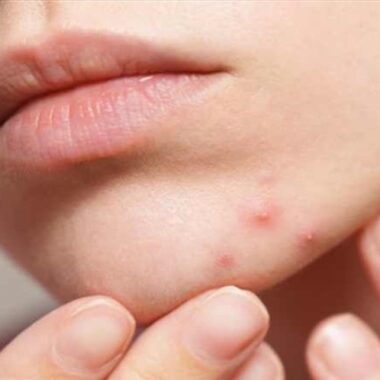 Acne / Pimples